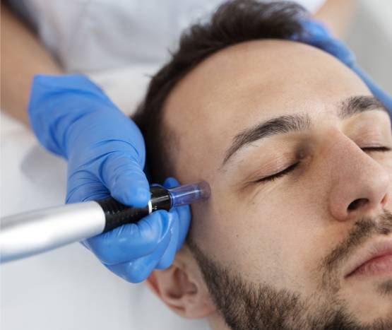 Micro Needling Treatment